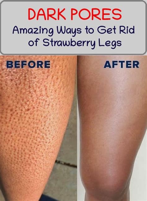 How To Finally Get Rid Of Strawberry Legs Strawberry Legs Ingrown
