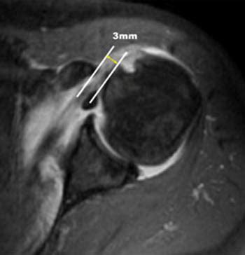 Rotator Cuff Tear With Biceps Tendon Dislocation Radsource