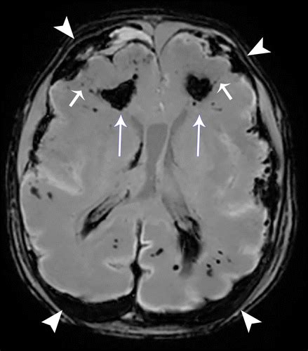 Imaging The Cerebral Veins In Pediatric Patients Beyond Dural Venous