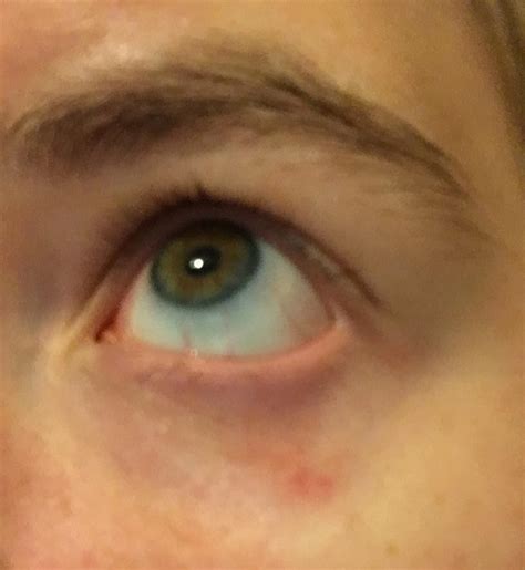 Skin Concerns Redness And Bumps Under Eye Went To Optometrist And It