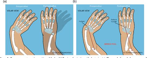 Figure 1 From The Paley Ulnarization Of The Carpus With Ulnar