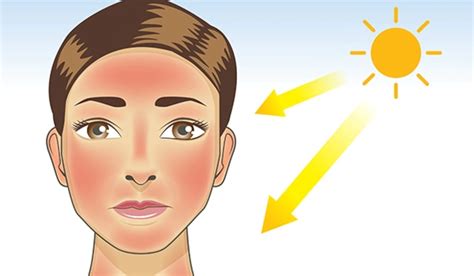 بهترین روش برای درمان آفتاب سوختگی مجله زندگی بهتر