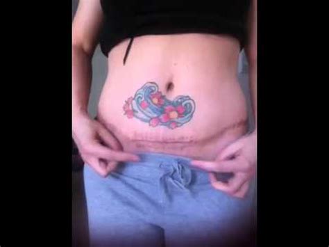 Wait for more than 18 months after a c section to conceive again. 2 weeks after c section, pregnant after tummy tuck - YouTube