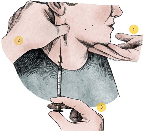 Procedure For A Safe Approach To Injection Of The Sternocleidomastoid