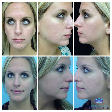 Top 101 Pictures Before And After Pictures Of Microneedling Full Hd 2k 4k