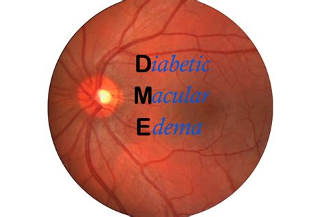 Diabetic Macular Edema Diagnosis And Treatment Board Certified Eye