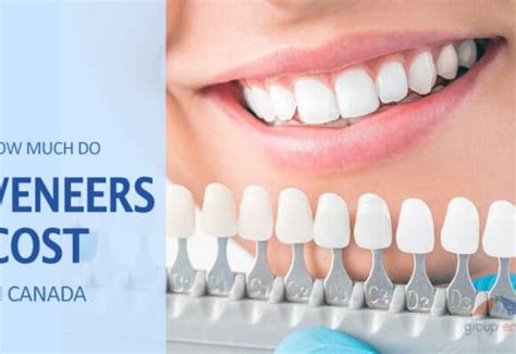 How much do veneers cost? All About Root Canal Cost, Signs and Treatment in Canada