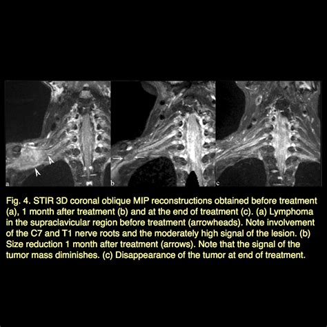 Mri Blog Brachial Plexus Mri Iiii