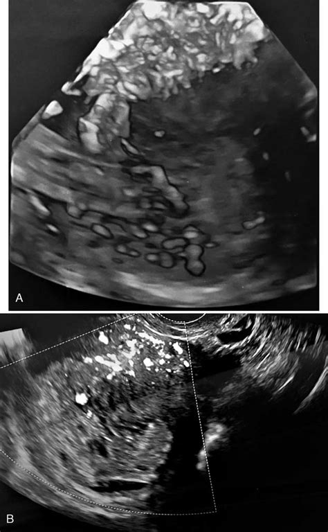 Transvaginal Ultrasound Examination Of The Case 1 Before Dandc