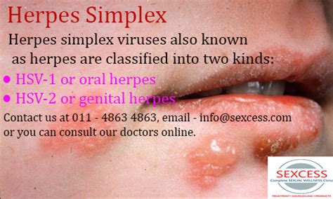 Hsv 1 Pictures In Mouth Oral Herpes Stock Image C010 5979 Science Photo Library Herpes