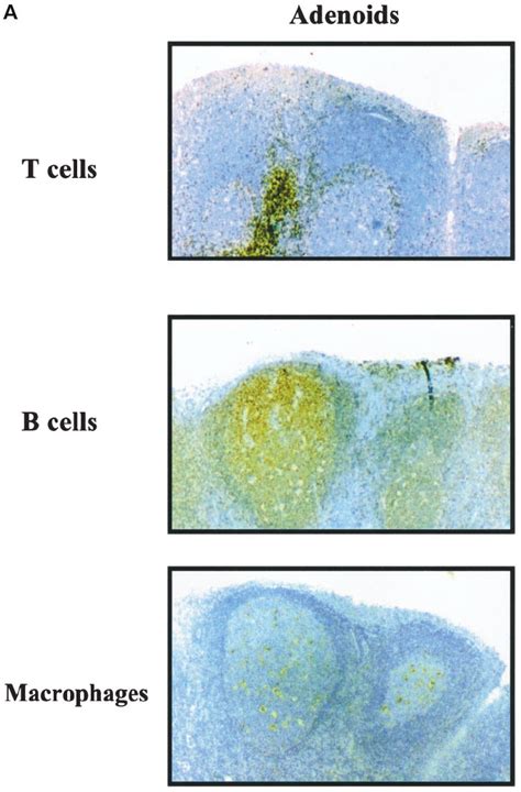 Lymphoid Cell Composition Of Human Tonsils And Adenoids As Determined