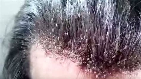 The Most Disgusting Head Lice Infestation You Will Ever See Thatviralfeed