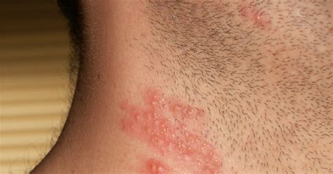 Allergic Reaction Skin Rash Treatment Healthhub