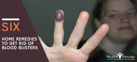 How To Deal With Blood Blister On Finger