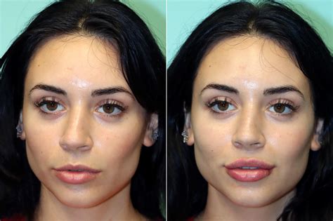 Lip Augmentation Photos Chevy Chase Md Patient 17548