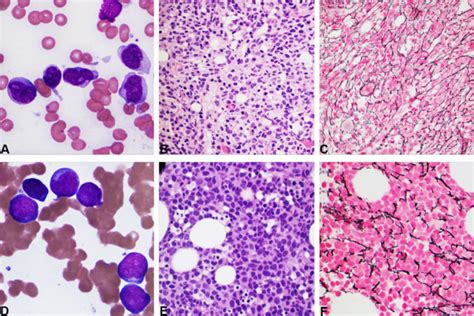 Iamp21 In Acute Myeloid Leukemia Is Associated With Complex Karyotype