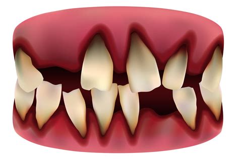 Bleeding Gums And Loose Teeth Berwick Dental Studio Dentist Berwick