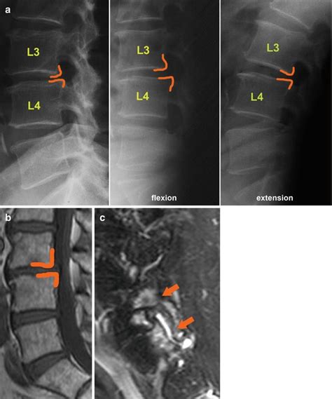 Spine Instability Radiology Key