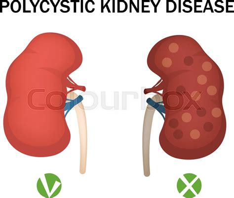 Polycystic Kidney Disease And Healthy Stock Vector Colourbox