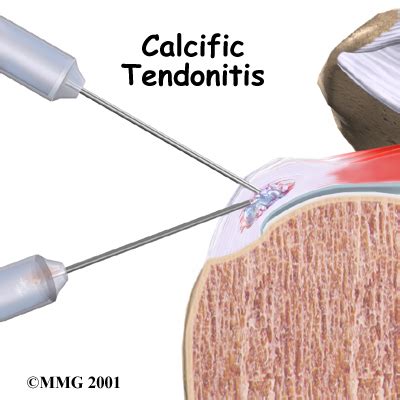 Physical Therapy In Baton Rouge For Shoulder Calcific Tendonitis