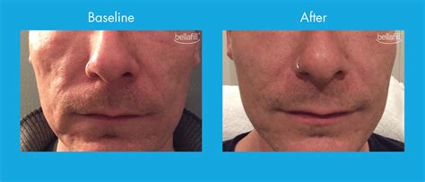 Bellafill Treatment For Acne Scarring In New Jersey Soma Skin And Laser