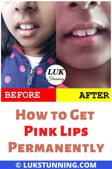 How to treat dandruff at home | 5 home remedies to get rid of dandruff naturally method. How to Get Pink Lips Fast Permanently in 2020 | Lips, Pink ...