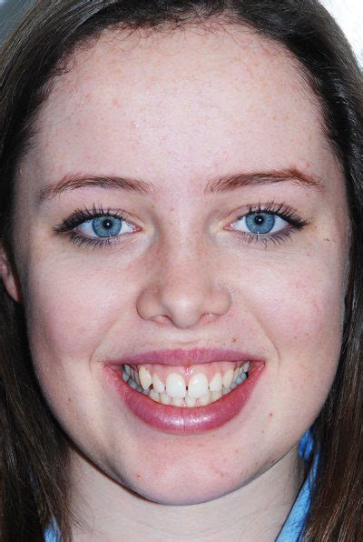 Protrusion Of Teeth And Gums Billericay Orthodontics