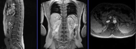 Magnetic resonance imaging (mri scan) was developed in the 1980's and has revolutionized our ability to see normal and abnormal spinal structures and help diagnose what causes back pain. Multiple sclerosis (MS) MRI protocol and planning | MS MRI ...