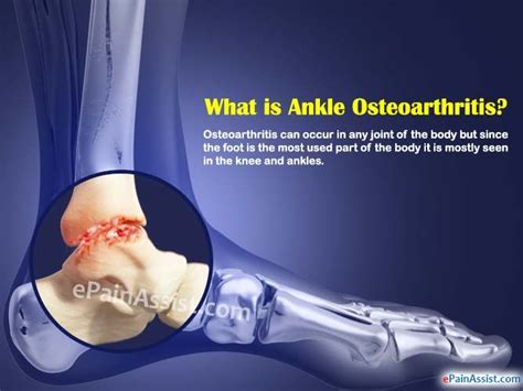 Ankle Osteoarthritis Causes Symptoms Treatment Recovery Diagnosis AnkleOst