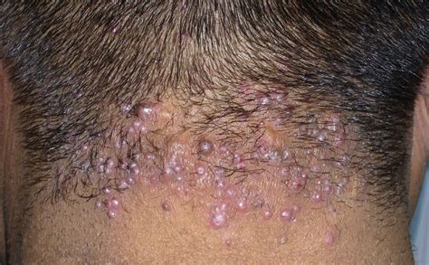 Acne Keloidalis Nuchae Causes Symptoms Diagnosis Treatment