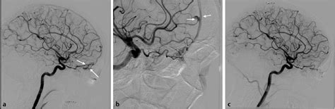 Preoperative And Postoperative Imaging Evaluation Of Arteriovenous
