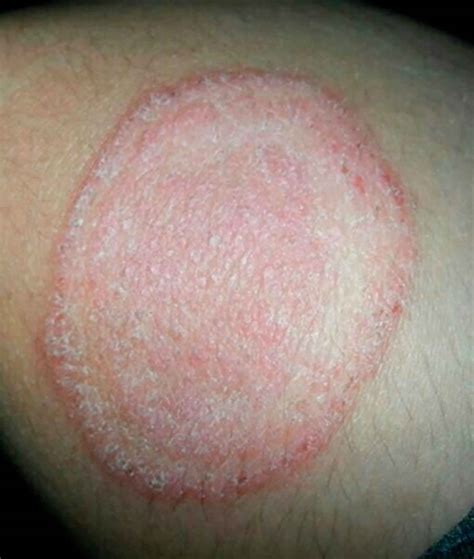 Tinea Corporis Patofisiologi Diagnosis Penatalaksanaan Alomedika The