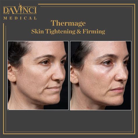Da Vinci Clinic Facelift And Face Contouring Using Thermage