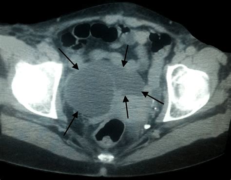 Ct Of The Abdomen And Pelvis Showing Inhomogeneous Tumor Mass In The