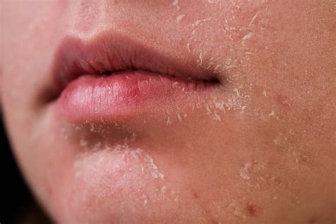 What Causes Dry Skin How To Treat It Products To Try And Is It