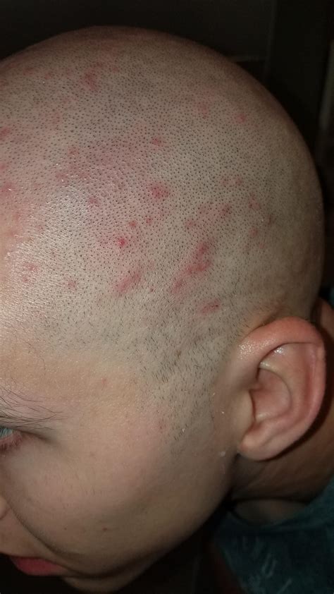 Bumps On Neck After Haircut Best Haircut