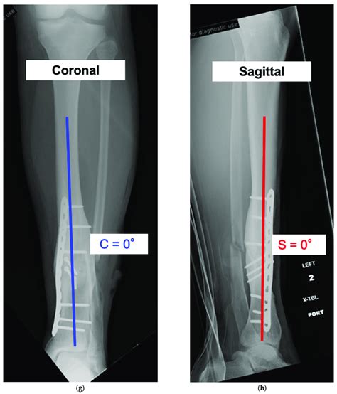 See Case 2 Description For Details Of A Tibial Malunion A H