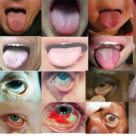 Examples Of A Eye B Tongue Pallor Site Images With Varying