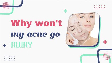 Your Acne Wont Go Away Best Acne Treatments Medzpalace