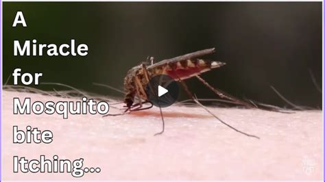 Stop Mosquito Bite Itching Instantly With This Miraculous Remedy Youtube