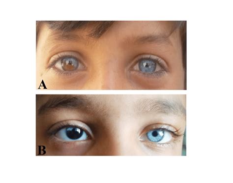 Sectoral Heterochromia In Affected Male Children A Case 1 B Case 2