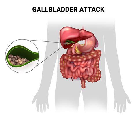How To Recognize The Symptoms Of A Gallbladder Attack Manhattan
