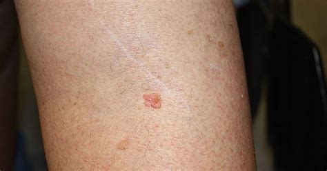 Doctor Warns That Itchy Skin Spot May Suggest More Investigation Cbs
