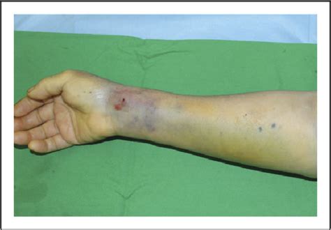 Figure 1 From Acute Compartment Syndrome Of The Forearm Associated With