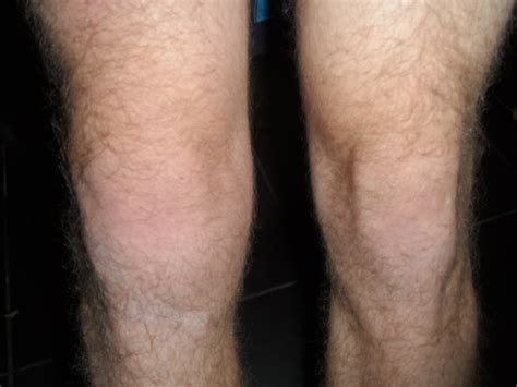 Hi The Bottom Of My Knee Has Been Swollen For 4 Weeks Know