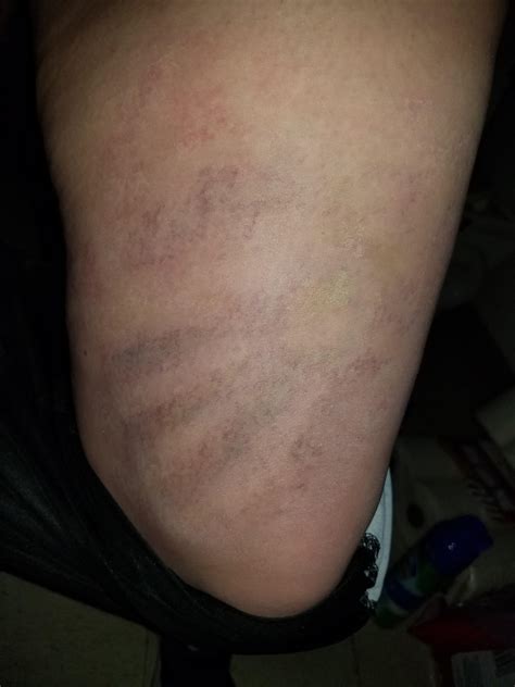 Handprint Bruise On Arm