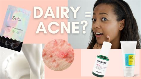 Does Dairy Cause Acne Style Story