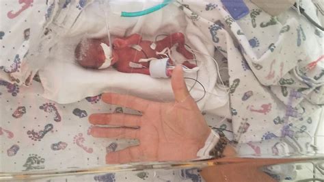 ‘remarkable Tiny Baby Born Weighing Just 13 Ounces Wows Doctors With