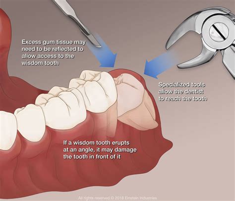 A wisdom tooth can put neighboring tooth at risk: Wisdom Teeth Removal