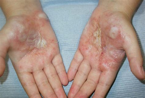 Bullous And Vesicular Disorders An Overview